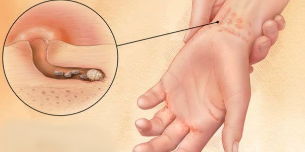 Аллергия на пальцах рук пузырьки лечение