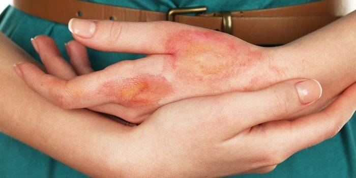 Буллезный дерматит