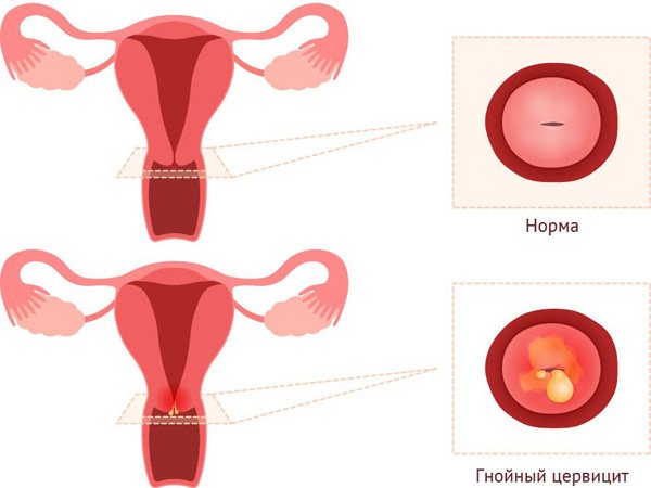 Цервицит при эндоцервикальной кисте