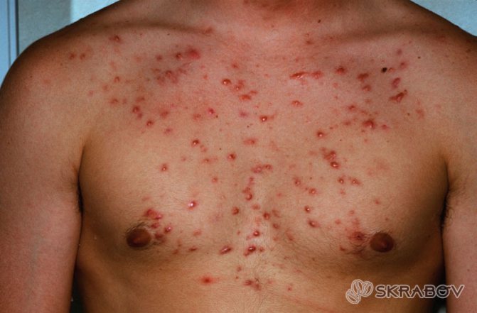 Черные точки на груди: эффективные методы избавления 1-2