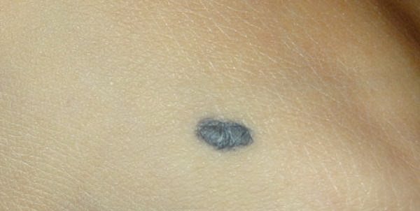 Что такое голубой невус: причины появления, опасные симптомы, необходимость удаления