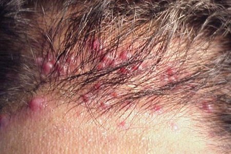 Демодекоз кожи головы