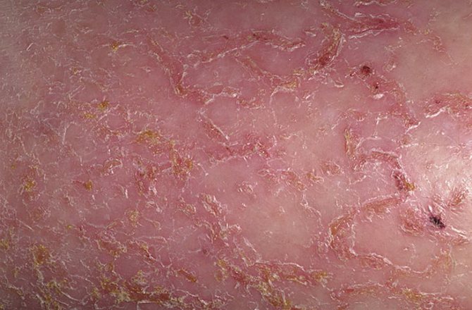 Экскориация при сухой экземе