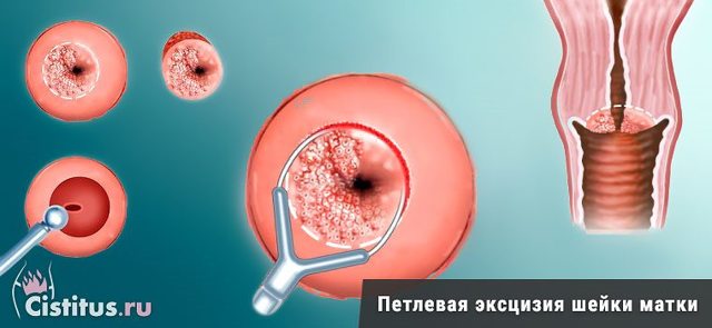 Электроэксцизия шейки матки: показания, ход операции и последствия