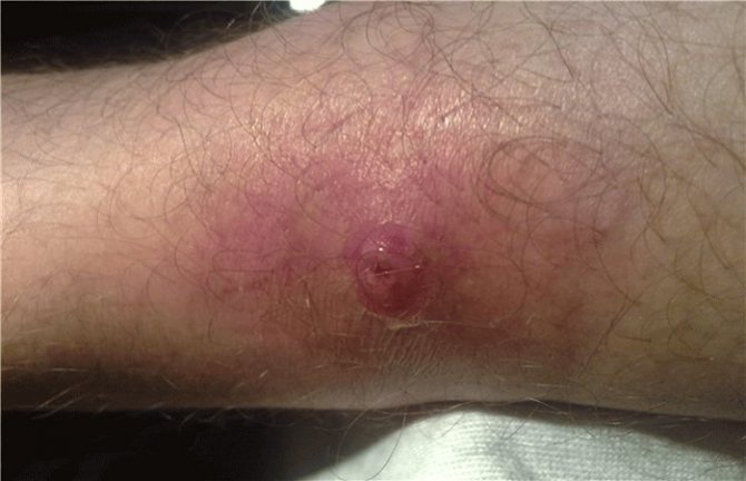 фурункул на ноге