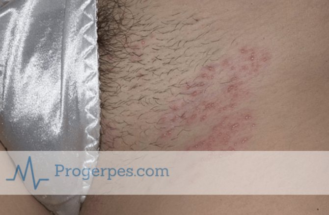 герпес в интимной зоне при беременности лечение