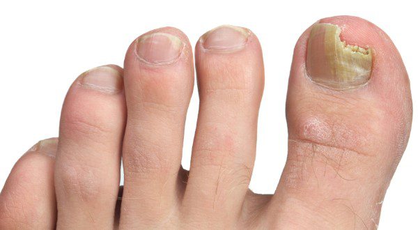 грибок ногтей