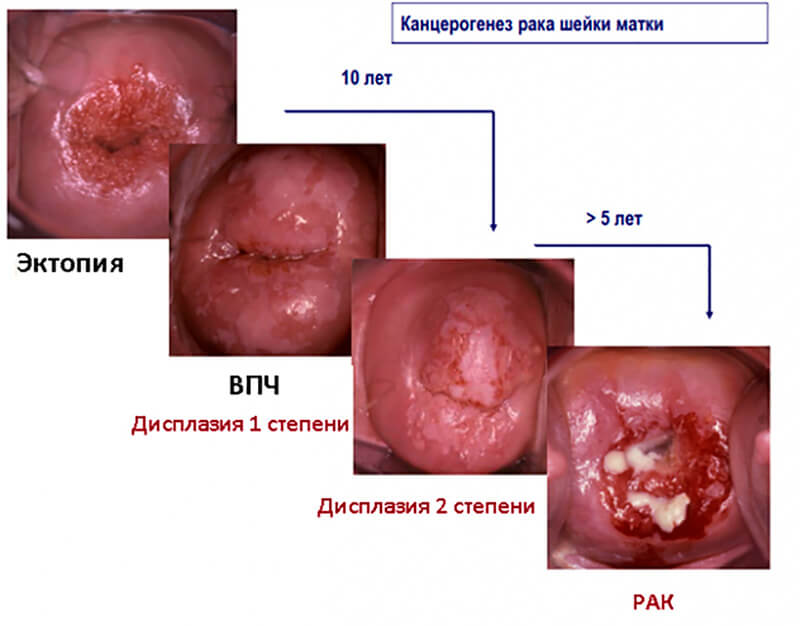 Изображение №1, Дисплазия шейки матки - клиника Альтравита