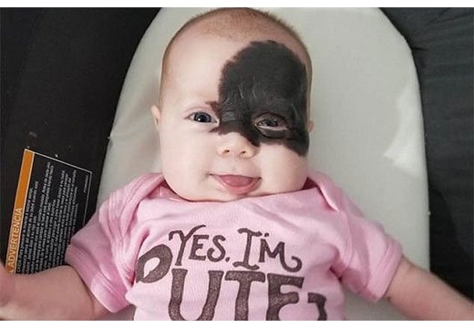 kak udalit rodimoe pyatno 4 - Как избавиться от родимого пятна на лице