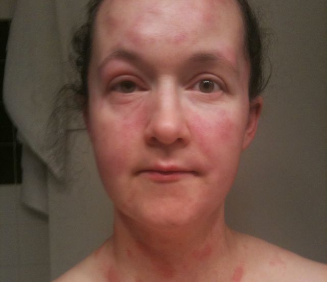 Крапивница у взрослого