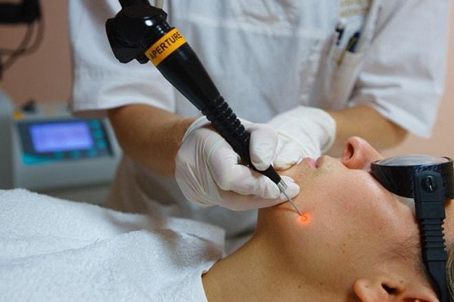 Лазерное удаление бородавки