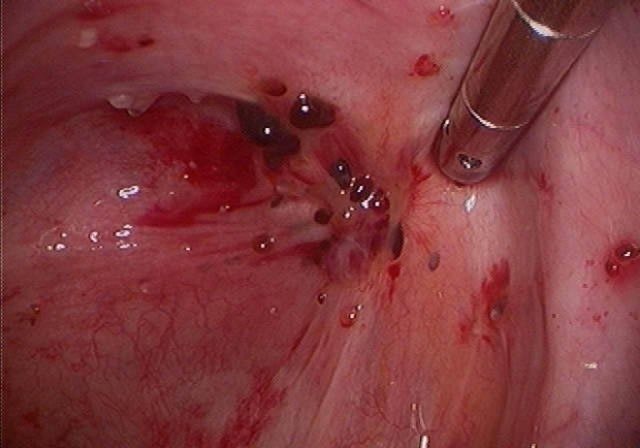 Множественные кисты на шейке матки