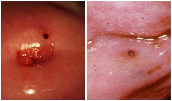 Небольшие эндометриоидные кисты на шейке матки не препятствуют беременности