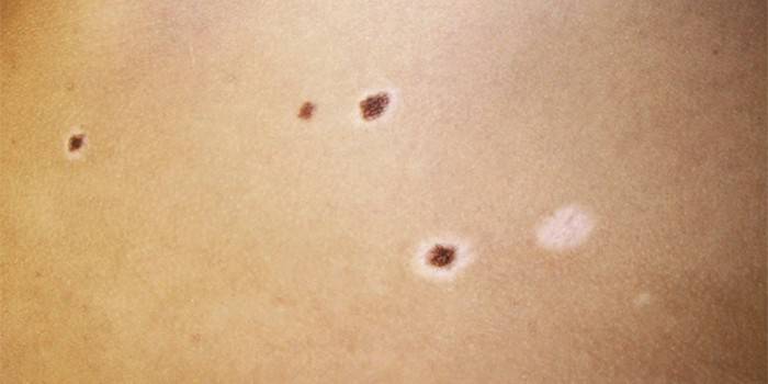 Невус Сеттона на коже человека