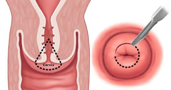 Ножевая конизация шейки матки