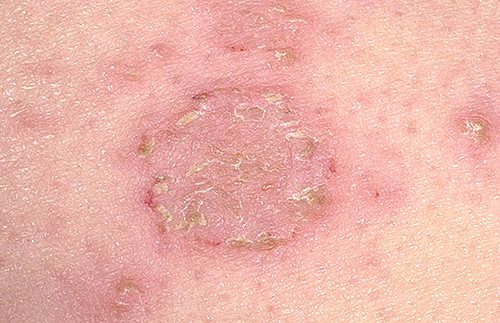 Острая форма экземы, подобно лесному пожару, может быстро распространяться, занимая все большие и большие площади