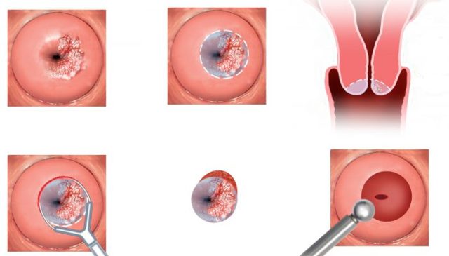 Плоскоклеточная метаплазия железистого эпителия — Твой гинеколог