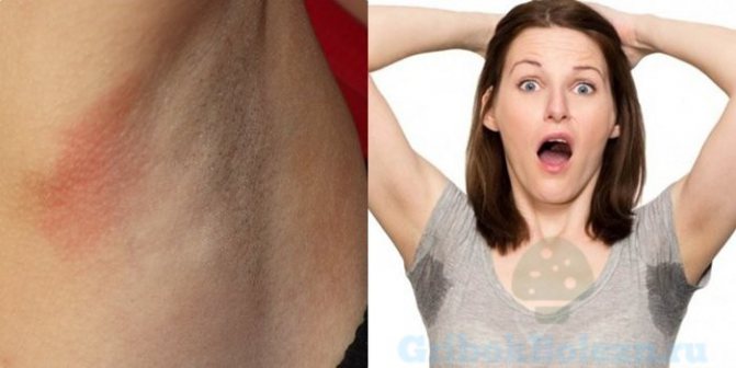 под мышками грибок