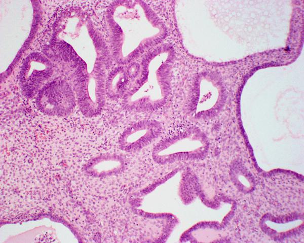 Полипоз Эндометрия