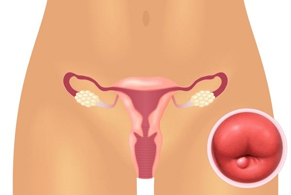Посмотрим, что собой представляют кисты эндоцервикса и нужно ли их лечить...