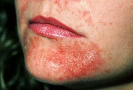 Пример кандидозного дерматита на лице