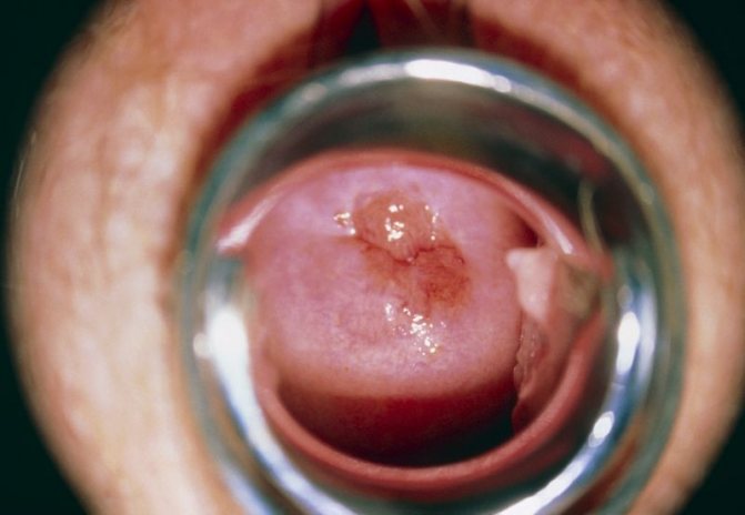 рак шейки матки