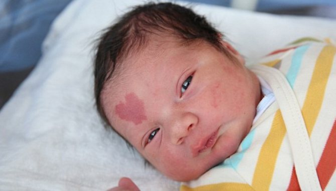 Родимые пятна у новорожденных