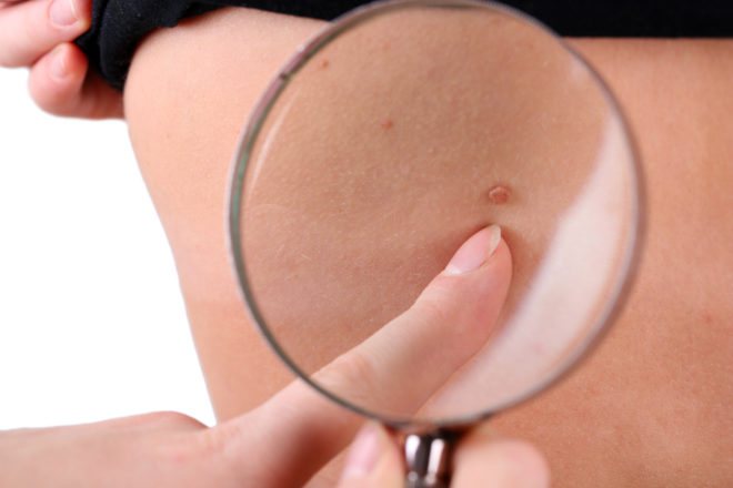 родинка посветлела