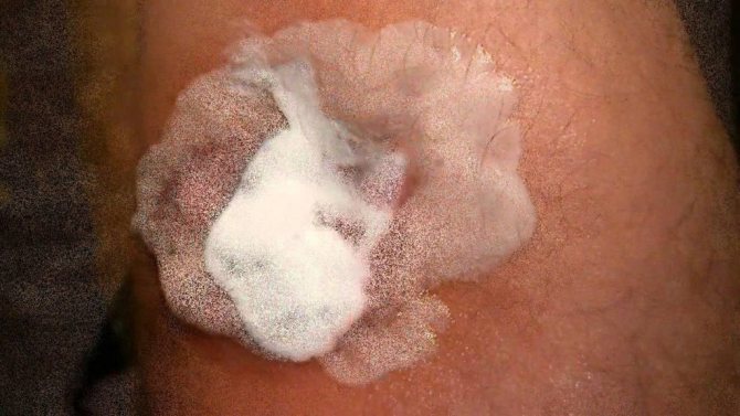 Симптомы ожога от йода и методы его лечения