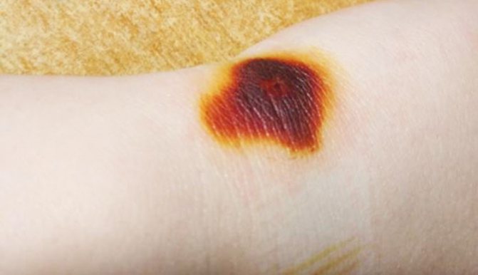 Симптомы ожога от йода и методы его лечения