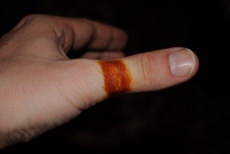 Симптомы ожога от йода и методы его лечения