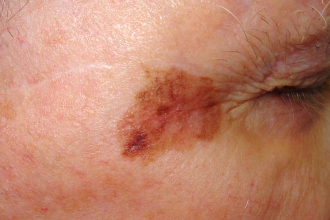 Старческое лентиго