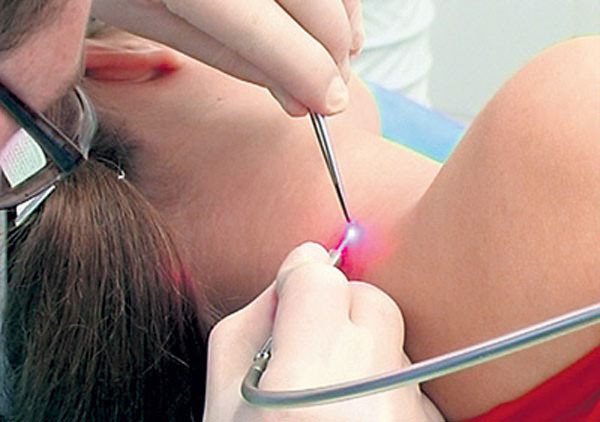 удаление лазером