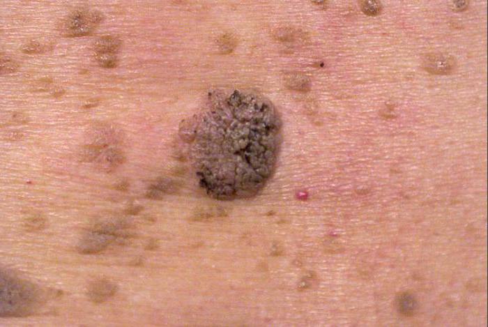 удаление папиллом в паху