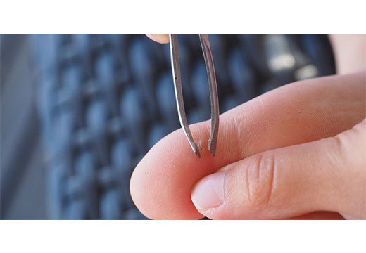 удалить бородавку на пальце