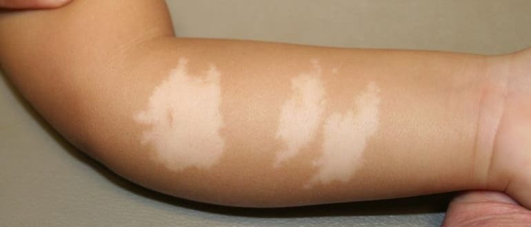 Витилиго у детей (21 фото): лечение и причины возникновения, симптомы на начальной стадии у грудничков и новорожденных