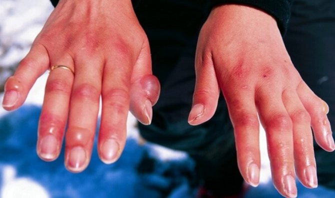 Воздействие холода на кожу