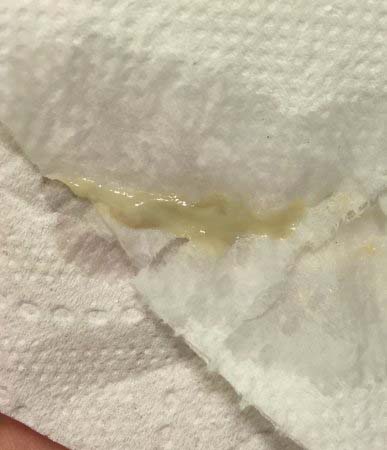 выделения зеленоватого цвета гинекология