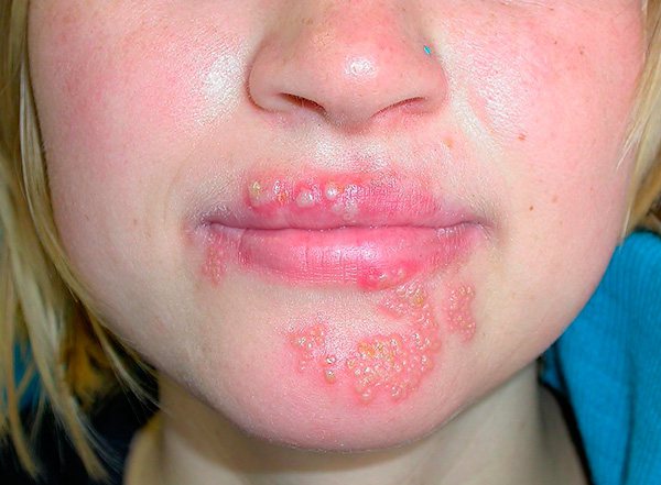 Знакомимся с особенностями так называемого хронического герпеса - почему он возникает очень часто и как лечиться в таких случаях...