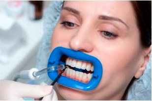 5. Очистка зубов от геля