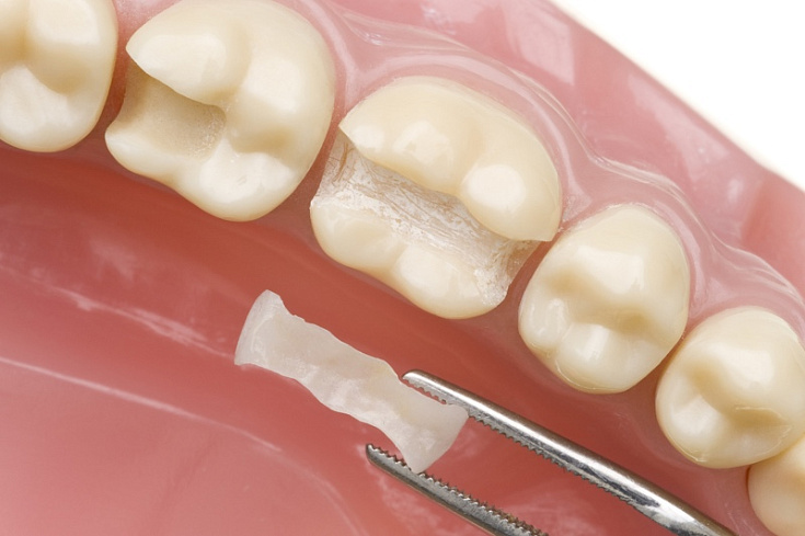 Керамические вкладки на зубы. Стоматология "Евродент" в Черкесске